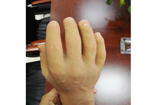 手指假肢